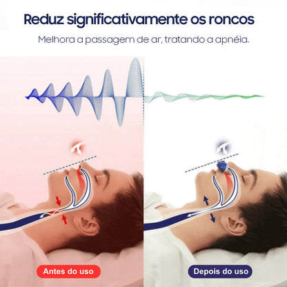 Dispositivo Eletrônico Mini-CPAP Anti-Roncos SonoFlux®